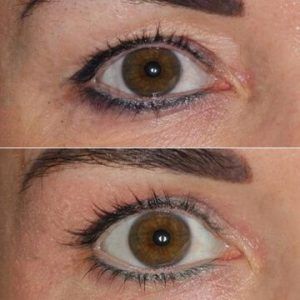 Plexr Plasma Eye Lift