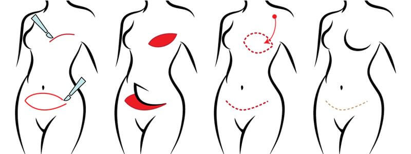 DIEP Flap Treatment