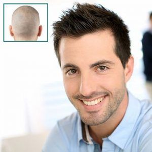 Scalp Micro Pigmentation