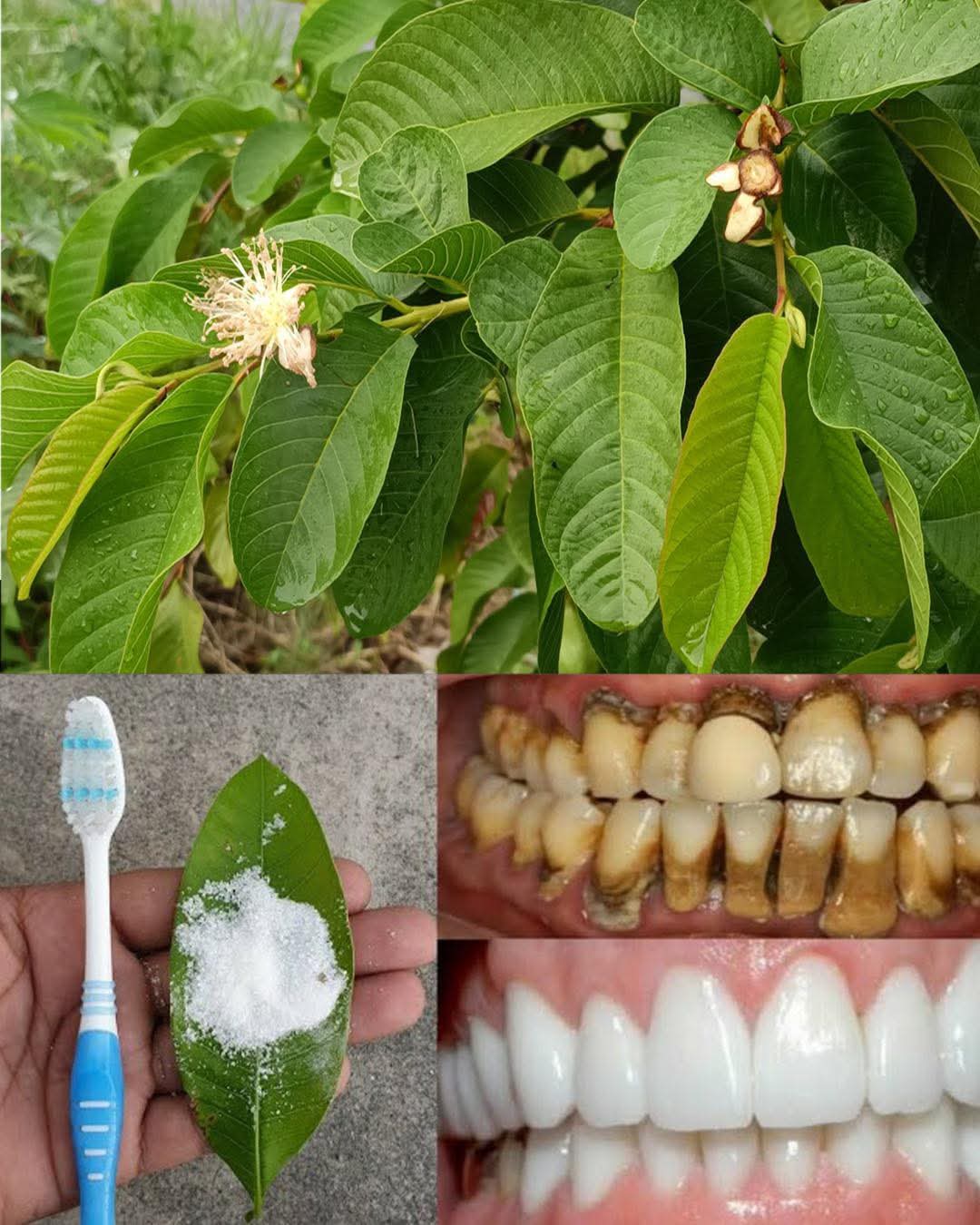 Top 3 Natural Remedies for Tooth Decay Using Guava Leaves