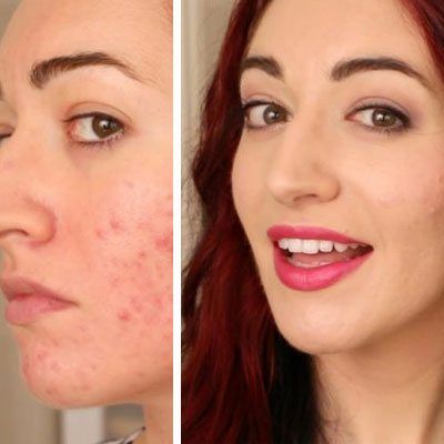 Acne Scar Treatment