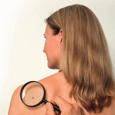 Birthmarks Treatment