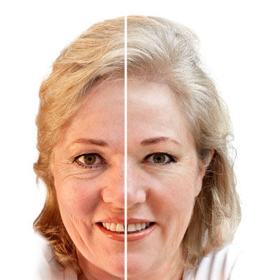 Fine Lines and Wrinkles