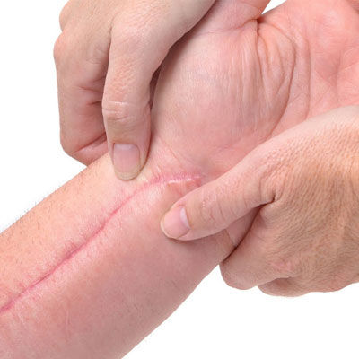 Post Surgical Scars