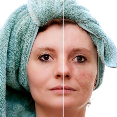 Skin Rejuvenation