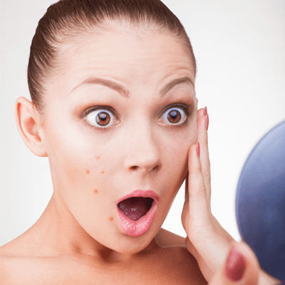 Acne-Treatment