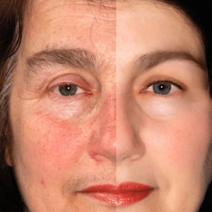 Rosacea-Treatment