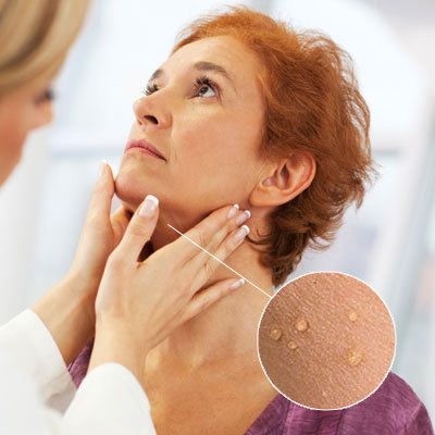 Skin Tag Removal Dubai