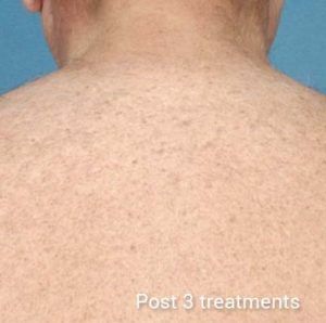 Laser-Hair-Removal-After-1-300x298