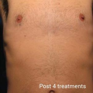 Laser-Hair-Removal-After-3-300x300