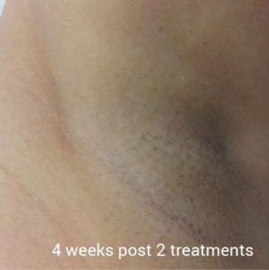 Laser-Hair-Removal-After-4-298x300