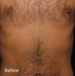 Laser-Hair-Removal-Before-3-297x300