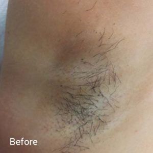 Laser-Hair-Removal-Before-4-300x300