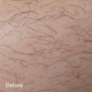 Laser-Hair-Removal-Before-5-300x300