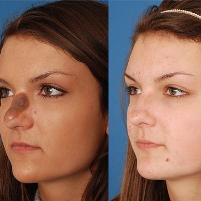 Skin Lesion Removal in Dubai, Abu Dhabi & Sharjah