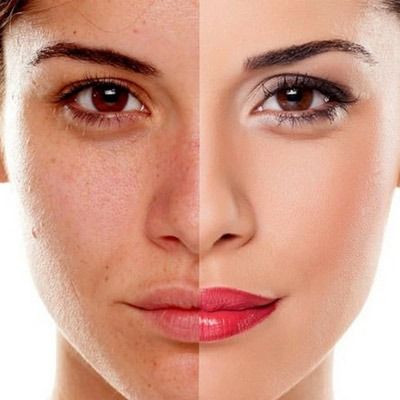 Microdermabrasion Treatment Cost In Dubai
