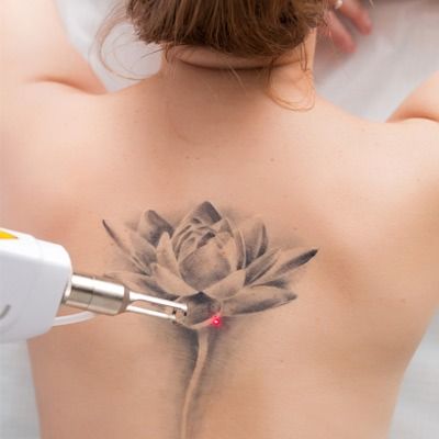 Picosure Tattoo Removal Dubai