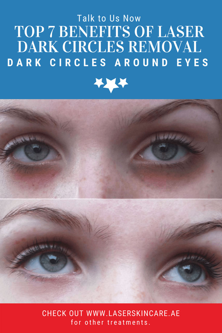 top-7-benefits-of-laser-dark-circles-removal