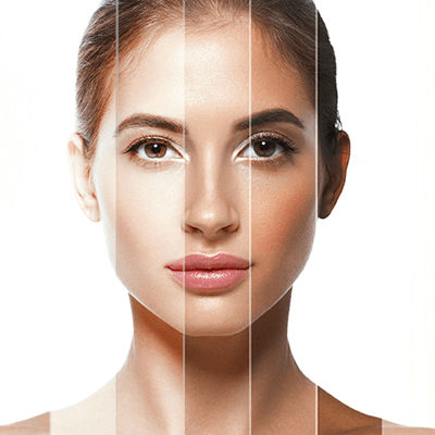 PICO Laser Treatment