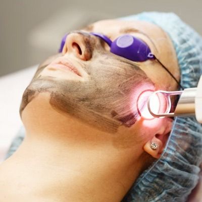Spectra Laser Carbon Peel in Dubai & Abu Dhabi