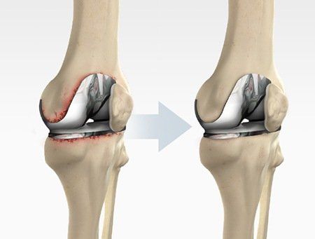 When Joint Replacement