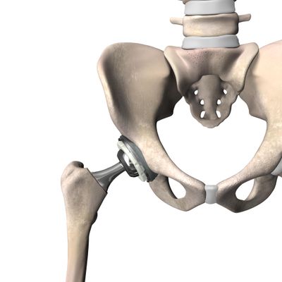 Anterior Hip Replacement