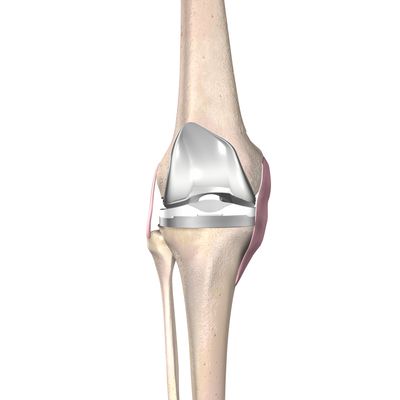 Total JiffyKnee® Replacement