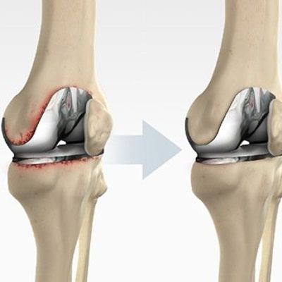 Revision Joint Replacement