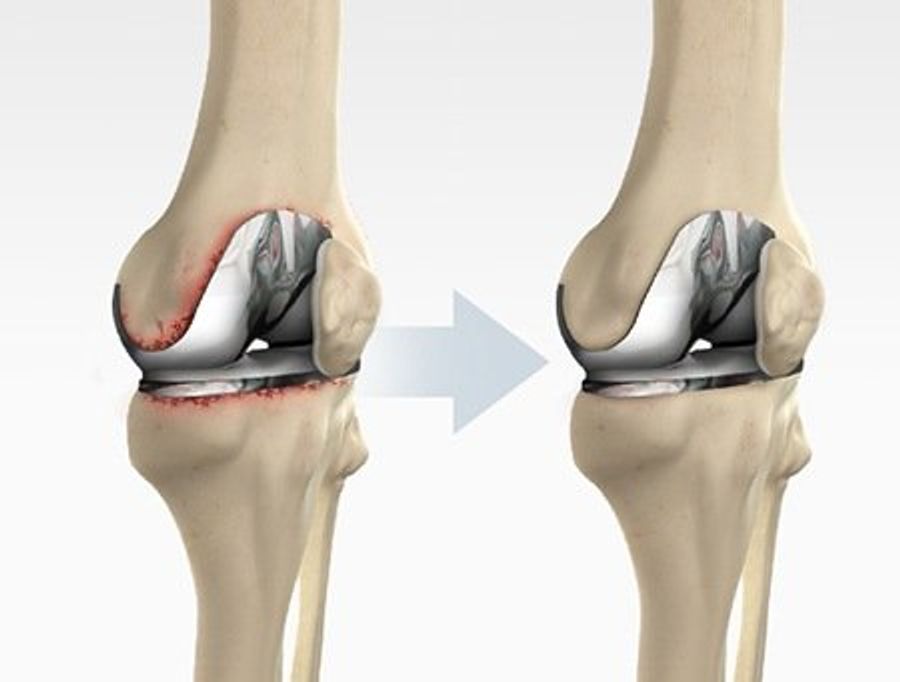 When Joint Replacement