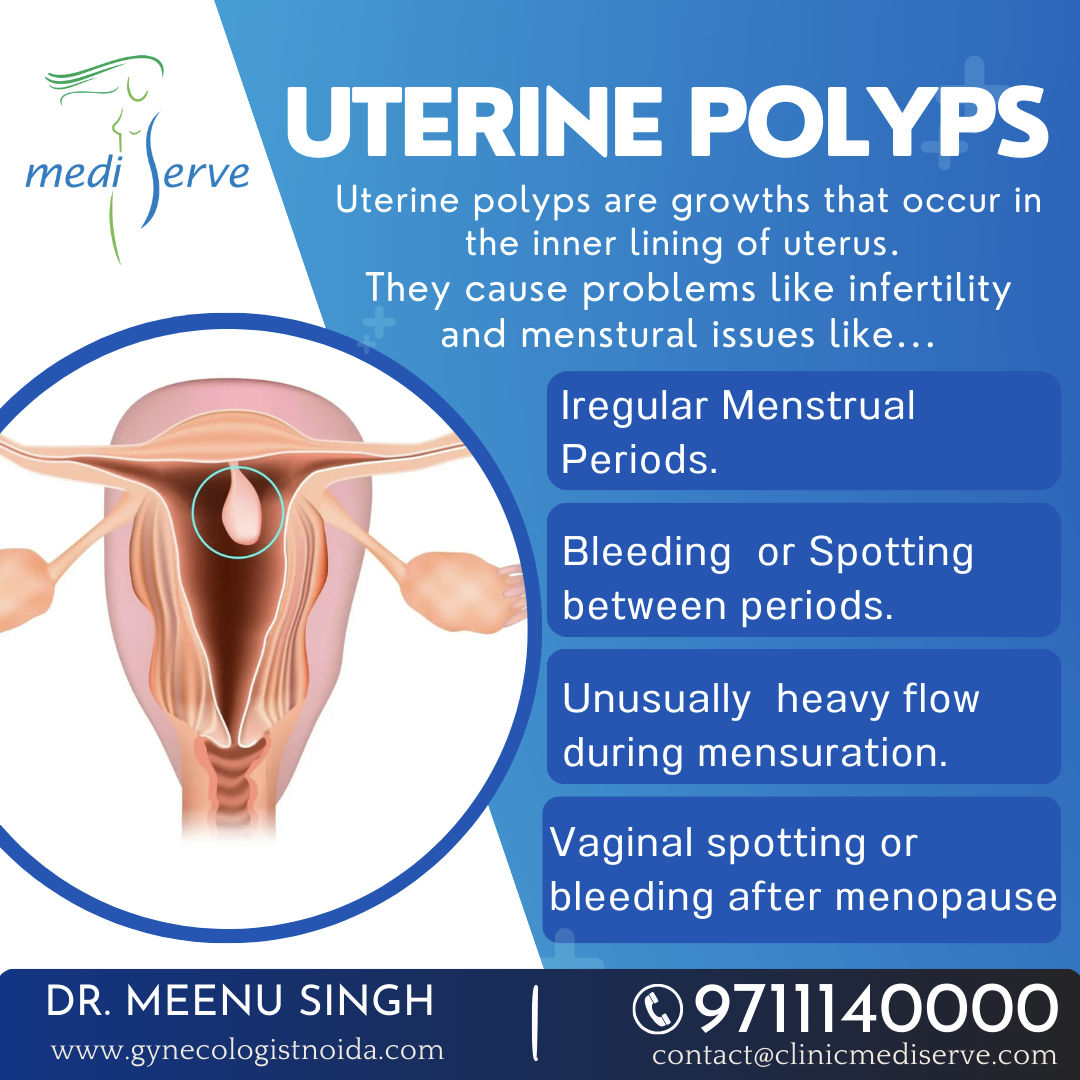 uterine polyps 1