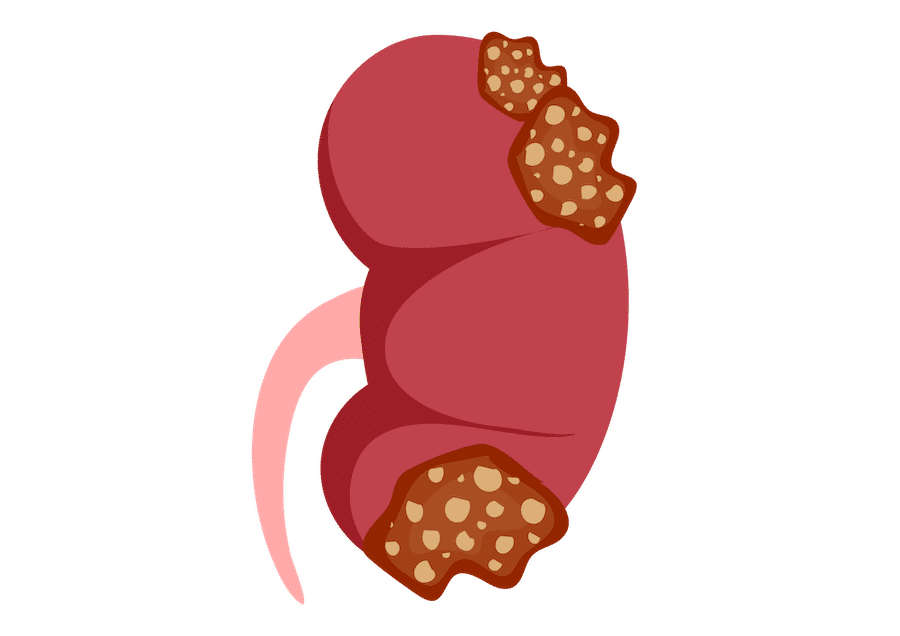 Acute Kidney Injury illustration