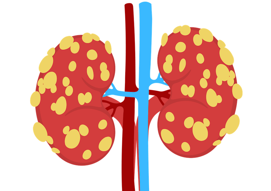 Chronic Kidney Disease illustration