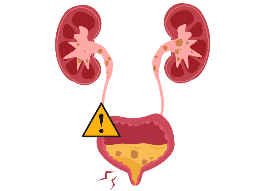 Complicated UTI illustration