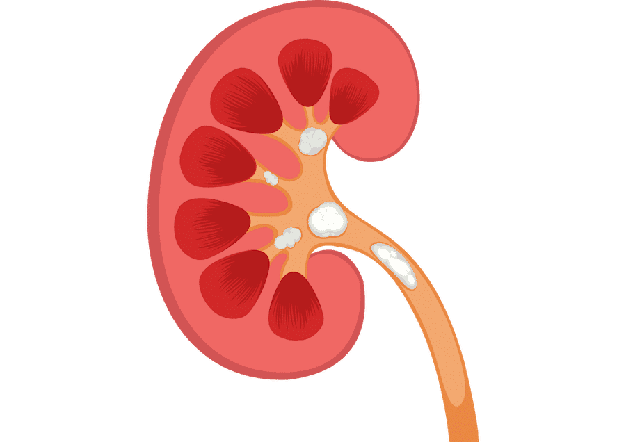 Renal Stone illustration