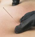 Dry Needling on OutpostLE Raleigh