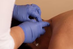 Лечение в Санатории Алеся - карбокситерапия (подкожные газовые уколы) Лечение в Санатории Алеся - карбокситерапия (подкожные газовые уколы)