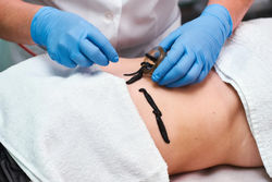 Лечение в Санатории Энергетик - гирудотерапия (лечение пиявками)