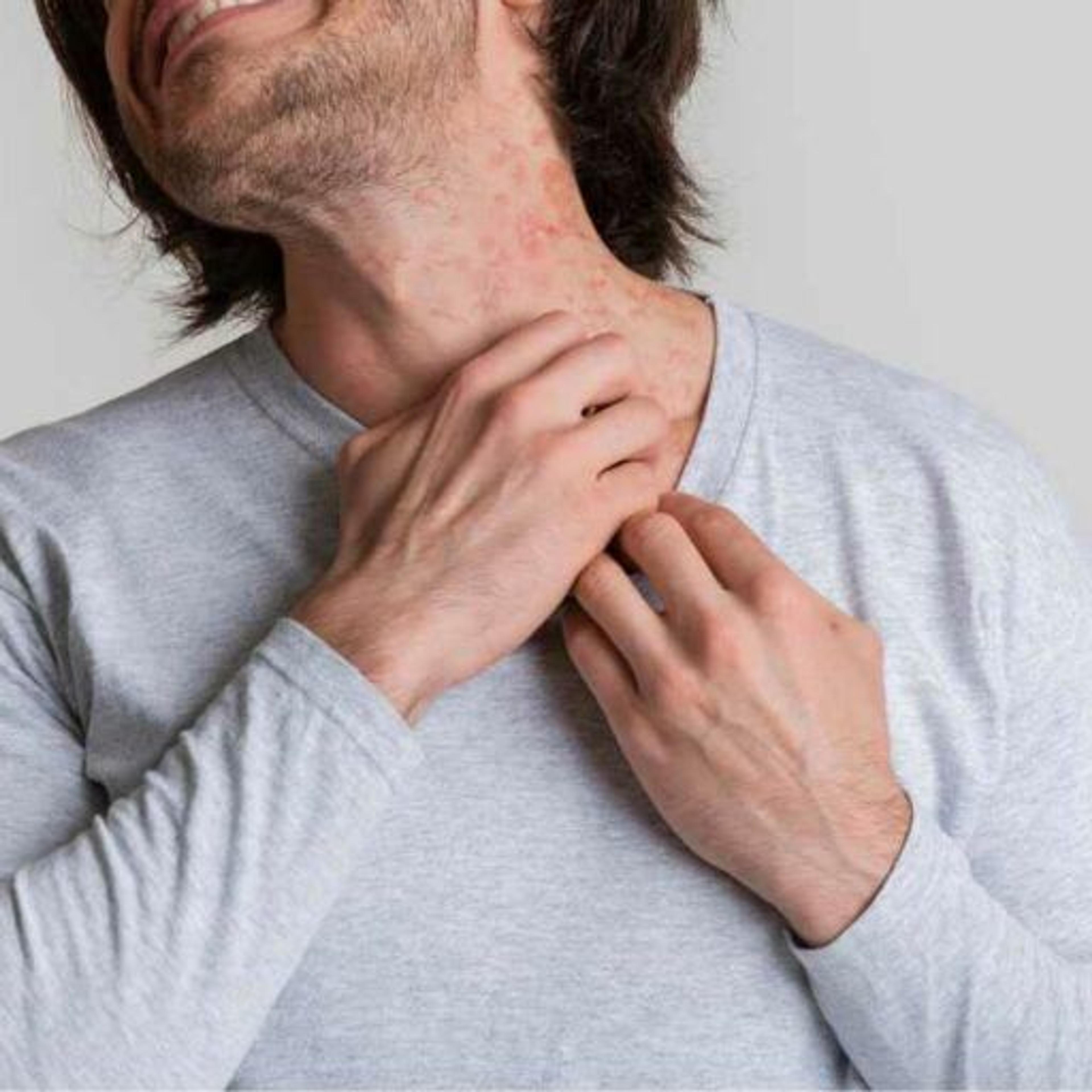 Allergy