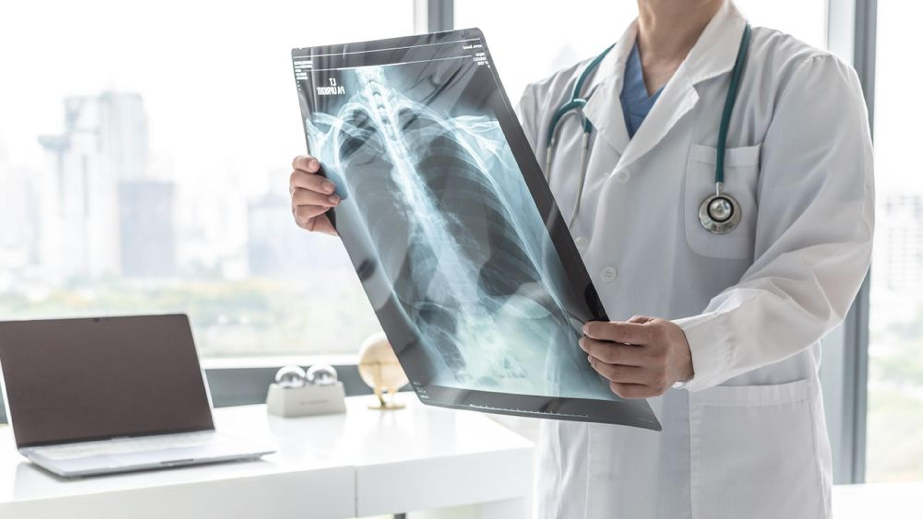 Chronic Obstructive Pulmonary Disease