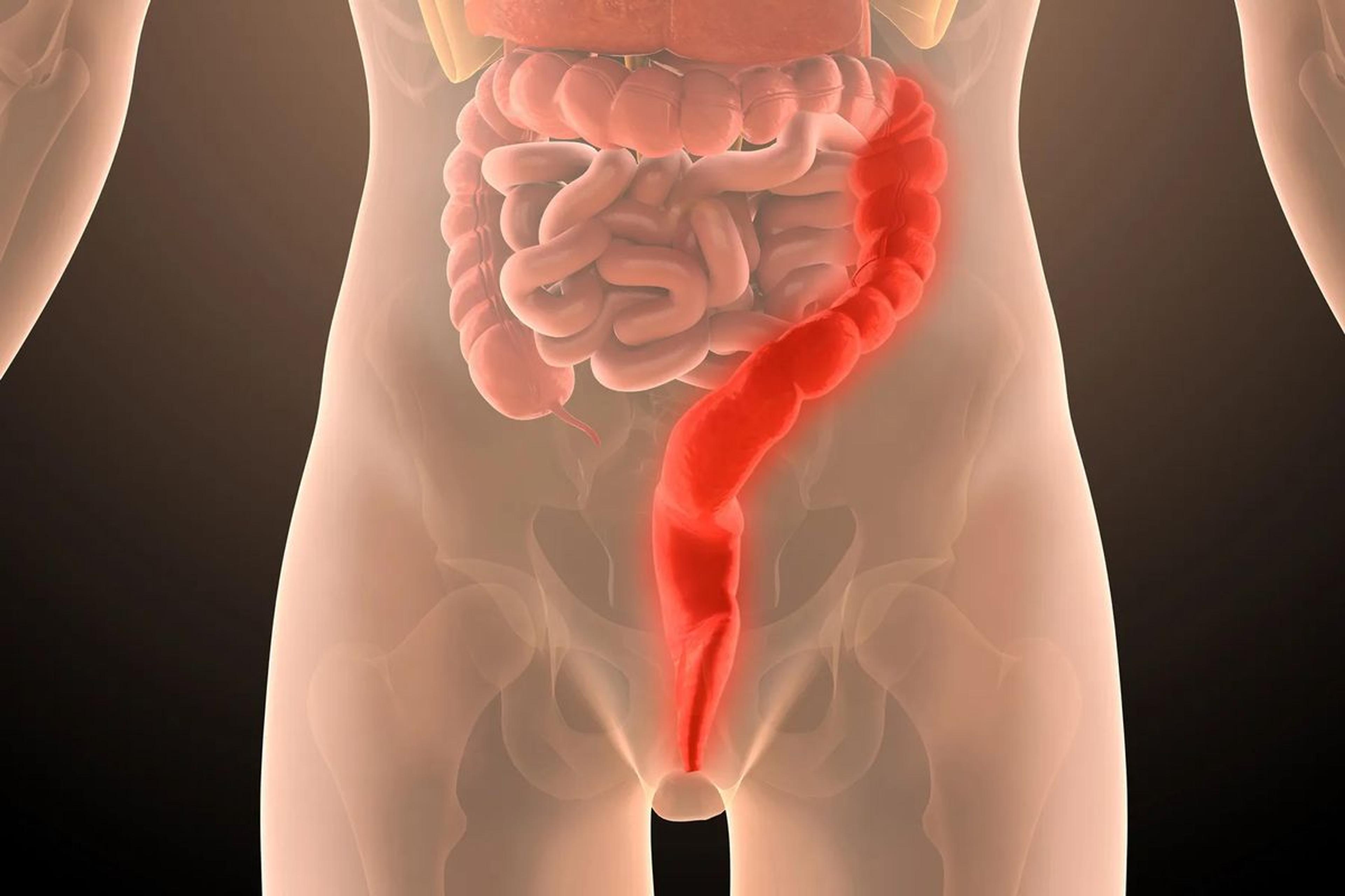 IBS (Irritable Bowel Syndrome)