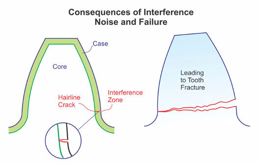 Figure 8—Tooth fracture initiated by interference.