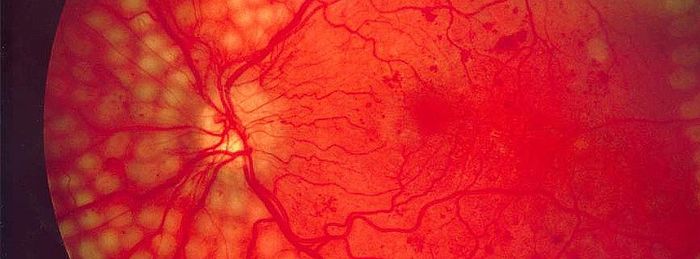 Detekce diabetické retinopatie českým softwarem dostala zelenou od úřadů