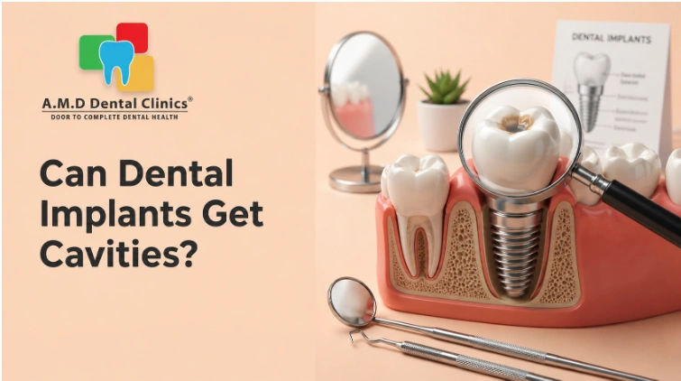 Can Dental Implants Get Cavities? | AMD Dental Clinic Jaipur