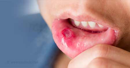 The Use of Medicine for Mouth Ulcers: For Your Good Health