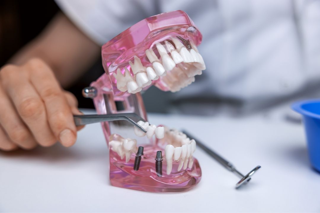 Helpful Things to Know About Multiple Dental Implants Helpful Things to Know About Multiple Dental Implants