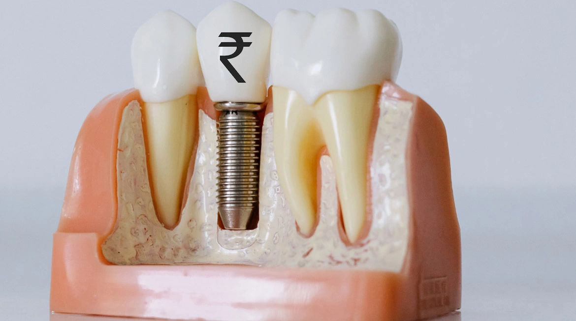 Dental Implant Cost in Jaipur – Is It Worth the Investment? Dental Implant Cost in Jaipur – Is It Worth the Investment?