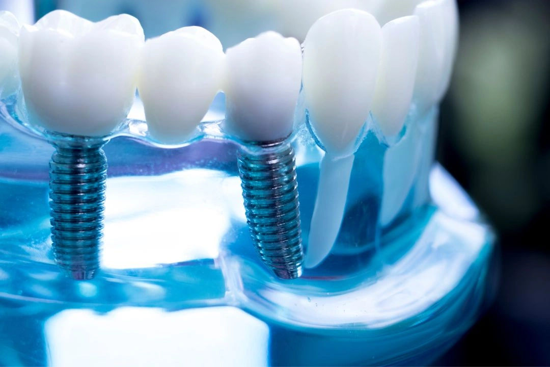 The Ultimate Guide to Dental Implants (2026): Procedures, Benefits, and Dental Implant Cost in Jaipur The Ultimate Guide to Dental Implants (2026): Procedures, Benefits, and Dental Implant Cost in Jaipur