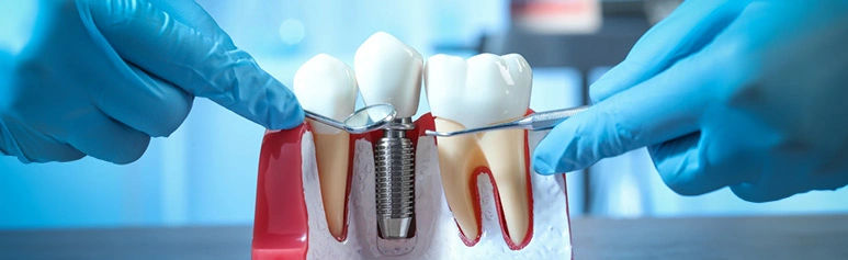 What to Expect After Getting Dental Implants? What to Expect After Getting Dental Implants?