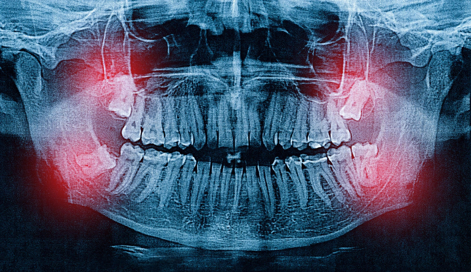 Can Wisdom Teeth Affect Your Other Teeth Alignment?