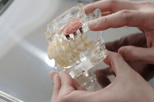 What is a Sinus Lift and Why is it Needed Before an Implant?